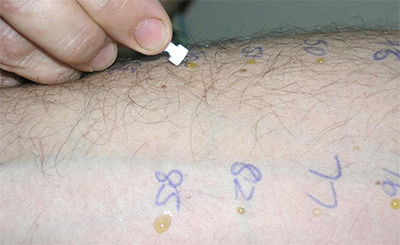 A patient undergoing an allergy skin prick test