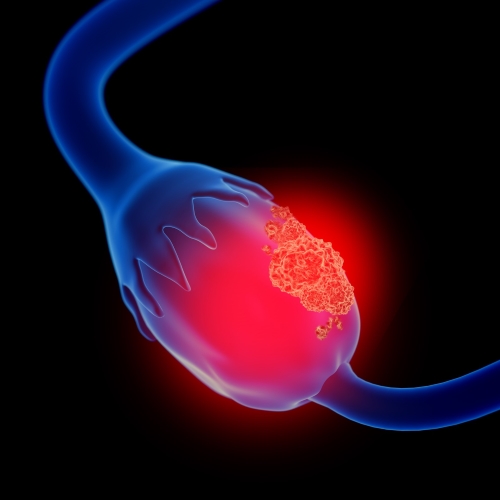 University of South Australia Discovers F2R Biomarker to Improve Ovarian Cancer Diagnosis and Treatment